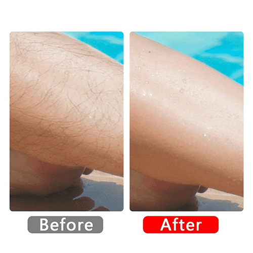 Before and after hair removal treatment comparison