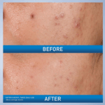 Cerave Acne Control Gel 2% Acne Treatment 40ml