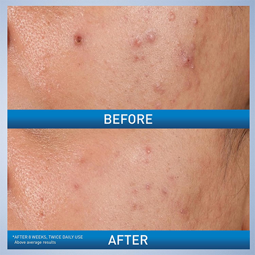 Cerave Acne Control Gel 2% Acne Treatment 40ml