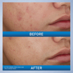 CeraVe Acne Control Foaming Face Cleanser 10% BPO 150ml