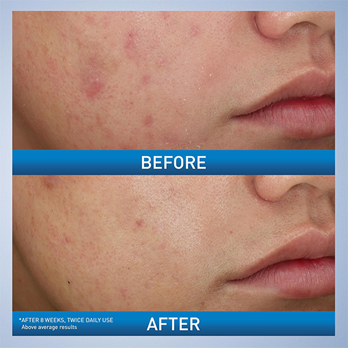 CeraVe Acne Control Foaming Face Cleanser 10% BPO 150ml